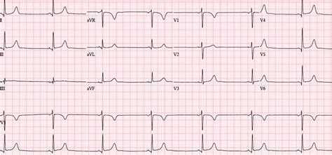 Bradycardia - Sinus Bradycardia Causes, Symptoms, Diagnosis, Treatment