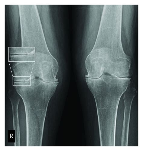 Rheumatoid Arthritis X Ray Knee