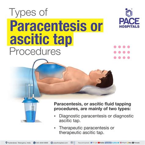 Paracentesis, Ascites Tapping in Hyderabad, India - Indication & Cost