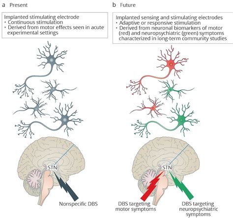 Neurotechnology holds promise for chronic stroke patients — Wyss Center