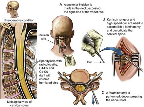 Cervical radiculopathy causes, symptoms, diagnosis & treatment