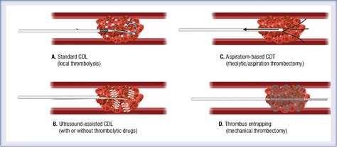 Catheter-directed therapy to treat intermediateand high-risk pulmonary ...