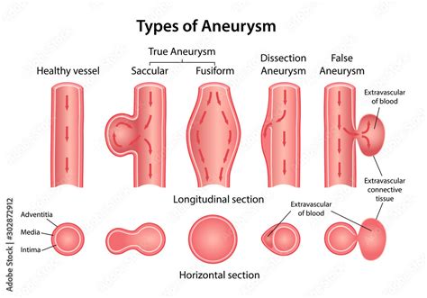 Vettoriale Stock Types of aneurysm: True Aneurysm (Saccular, Fusiform ...