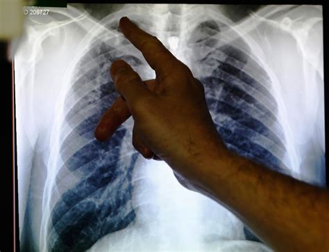 Tuberculosis Hits All-Time Low in the U.S. - NBC News