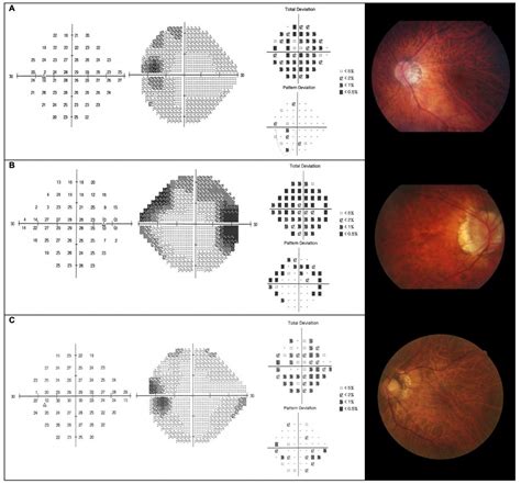 Visual field defects and myopic macular degeneration in Singapore adults with high myopia ...