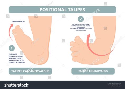 Bilateral Calcaneovalgus