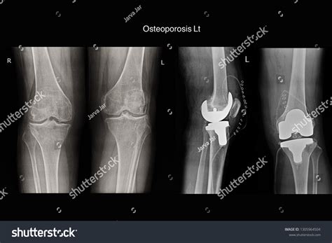 Osteoporosis Left Knee Post Operation Total Stock Photo 1305964504 | Shutterstock