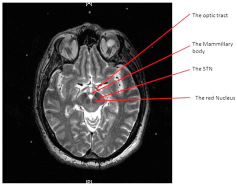 Substantia Nigra Red Nucleus