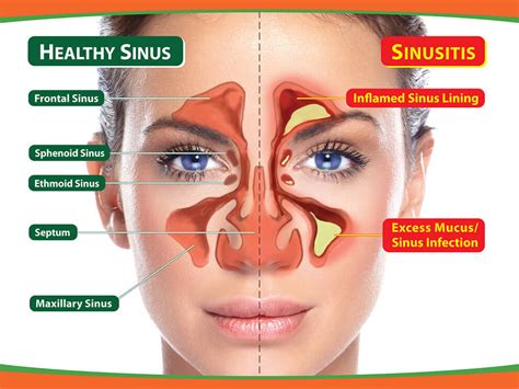 Sinus Pain In Face And Teeth Treatment - TeethWalls