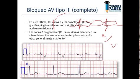 Electrocardiograma Normal Y Arritmias