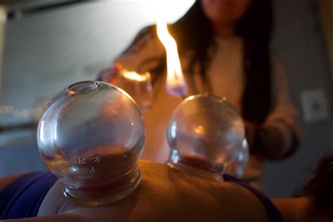 Fire Cupping — Synergistic Movement