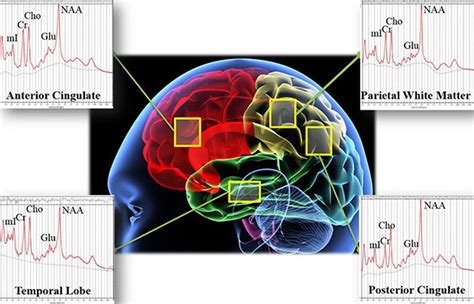 Brain Scans to Distinguish Between Brain Injury and PTSD - IEEE Spectrum