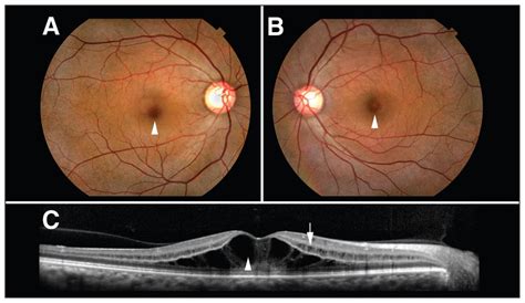 Cystoid macular edema associated with chemotherapy | CMAJ