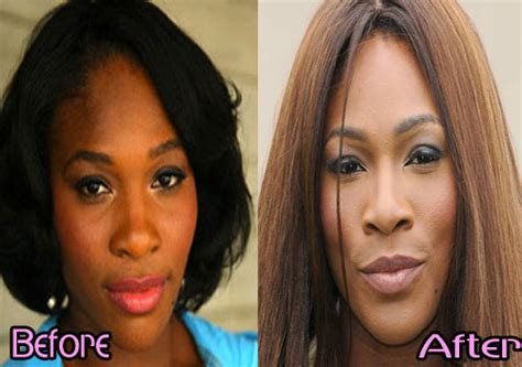 Serena Williams Plastic Surgery Before After Photos | Celebrities ...