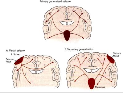 group_2_presentation_2_-_epilepsy - Wiki