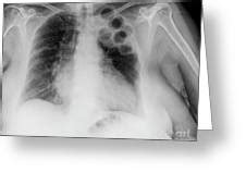 Plombage Tuberculosis Treatment Photograph by Science Photo Library - Fine Art America