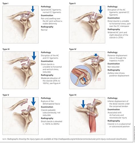 Acute Shoulder Injuries in Adults | AAFP