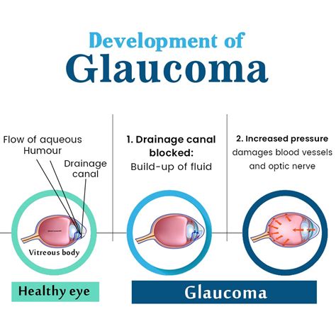 Glaucoma Surgery in Jalandhar, Punjab | Glaucoma Treatment Cost in Phagwara