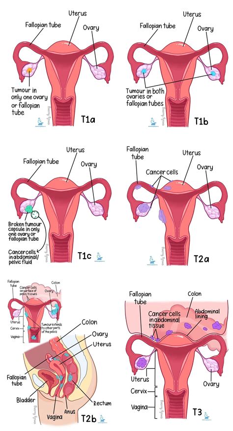 Where Does The Fluid Come From In Cardiac Tamponade