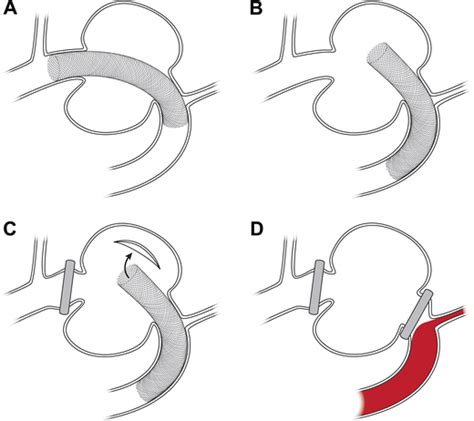 Illustration of the migration of the distal end of the Pipeline stent ...