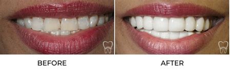 Porcelain Veneers vs. Lumineers: Which Is the Best Option?