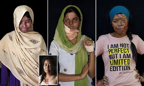 Harrowing images of acid attack survivors around the world | Daily Mail Online