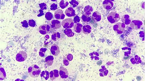 Eosinophilic Granuloma Histology