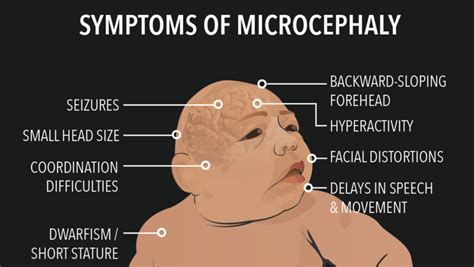 Is Zika the real cause of microcephaly in Brazil? New study raises ...