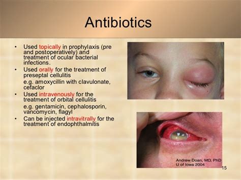 Oral Antibiotics For Eye Infection | Renew Physical Therapy