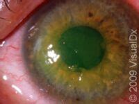 Recurrent Corneal Erosion: Causes, Symptoms, and Treatment