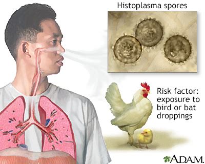 Histoplasmosis Information | Mount Sinai - New York