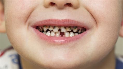 What Causes Children’s Cavities and How to Avoid Them - Scottsdale ...