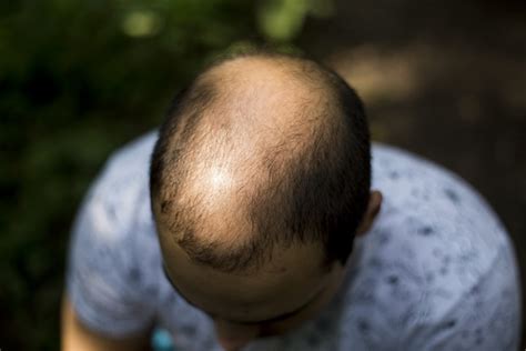 Commonly Asked Questions About Androgenic Alopecia Treatment - Dillon Hair Restoration in ...