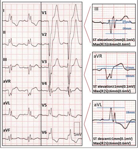 ECG from a patient with acute myocardial infarction and culprit artery... | Download Scientific ...