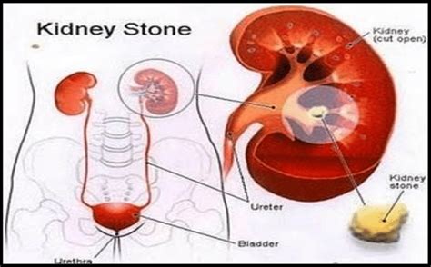 The incidence of urinary calculi was higher in administrative and... | Download Scientific Diagram