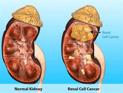 Renal Cancer Specialist - Non-Surgical Percutaneous Cryoablation