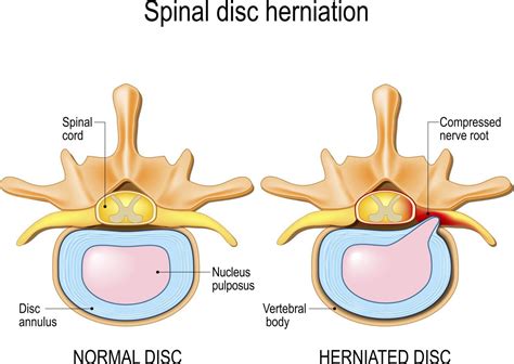 Lumbar Disc Injury | Vital-Balance