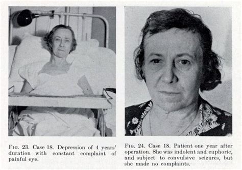 Lobotomy Procedure Steps