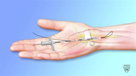 Thread ultrasound-guided carpal tunnel release - Mayo Clinic