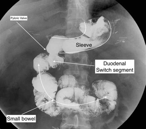 Revision of a Sleeve Gastrectomy or RNY - DSSurgery