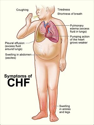 Home Health Care for CHF (Congestive Heart Failure)