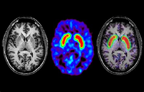 MRI in Parkinson Disease: Expanding Usability for Better Diagnostics - Neurology Advisor