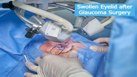 Understanding and Managing Swollen Eyelids After Glaucoma Surgery ...