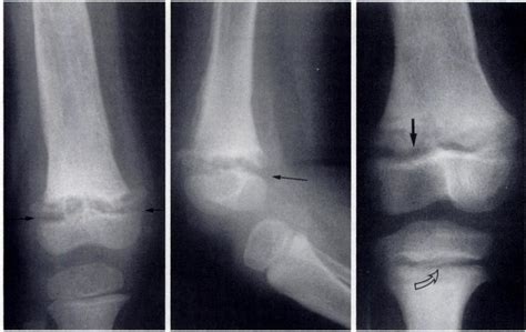 Physeal fracture. Anteroposterior (a) and lateral (b) radiographs show... | Download Scientific ...