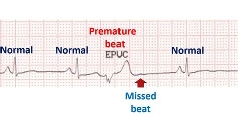 What causes missed beats? – All About Heart And Blood Vessels