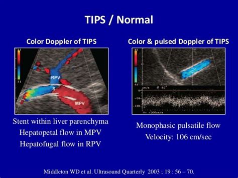 Doppler ultrasound of the portal system - Pathological findings