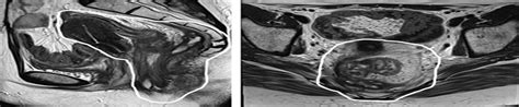 Improving Surgical Outcomes in Pelvic Exenteration Surgery:... : Annals of Surgery