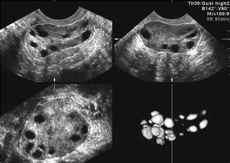 Polycystic Ovarian Syndrome Ultrasound - Quotes Trendy New