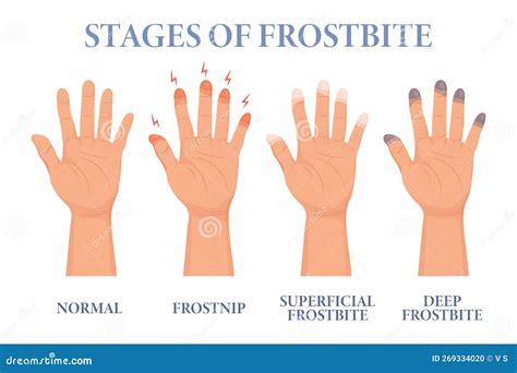 Frostbite Stages. Frozen Hands in Different Stages. Medical Frostbite ...