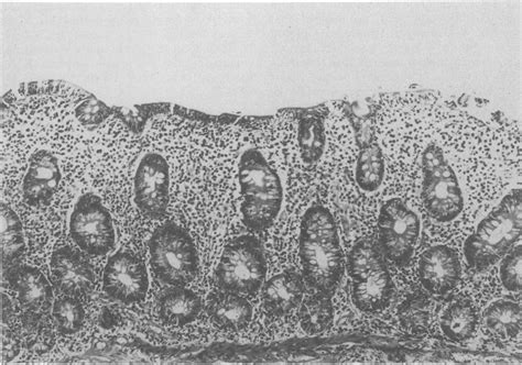 Small bowel biopsy showing total villous atrophy without sarcoid... | Download Scientific Diagram